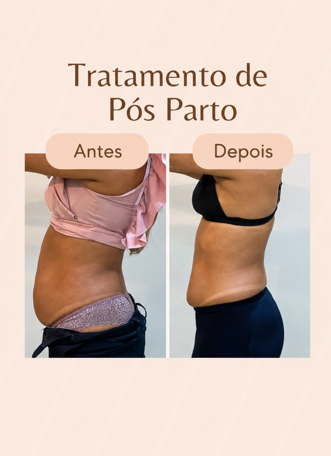 Antes e depois do tratamento pós-parto 2