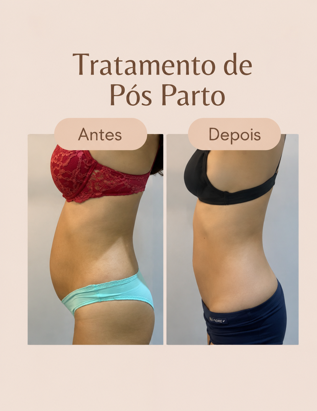 Antes e depois do tratamento pós-parto 4